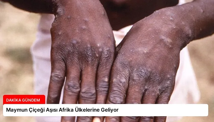 Maymun Çiçeği Aşısı Afrika Ülkelerine Geliyor